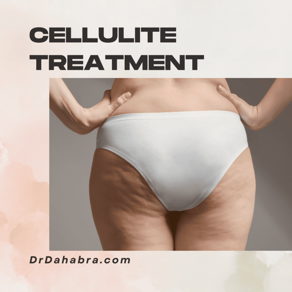 image of Cellulite Treatment Cost in Plantation, Florida