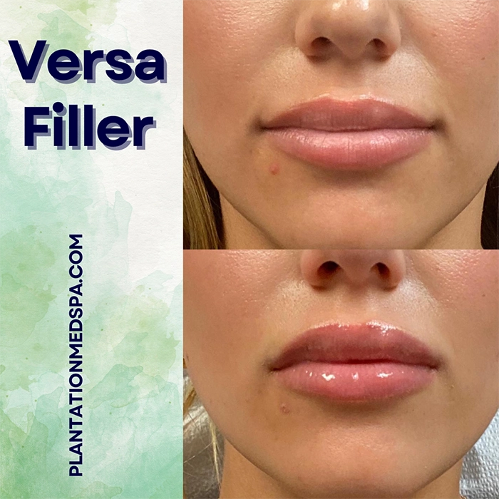 image of Versa Filler Cost in Plantation Florida