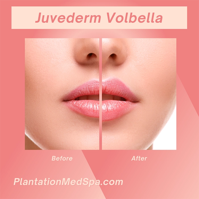 image of Juvederm Volbella Cost in Plantation Florida