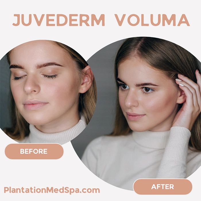 image of Juvederm Voluma Cost in Plantation Florida