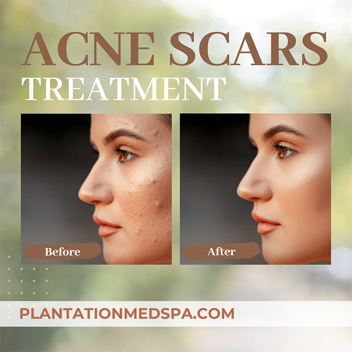 image of acne scars treatment cost in Plantation Florida