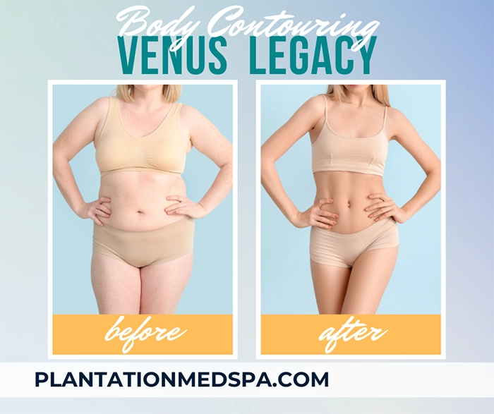 image of Venus Legacy body contouring cost in Plantation Florida