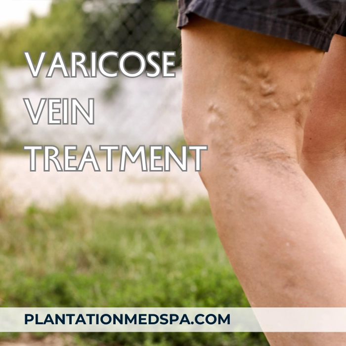 image of varicose vein treatment cost in Plantation Florida