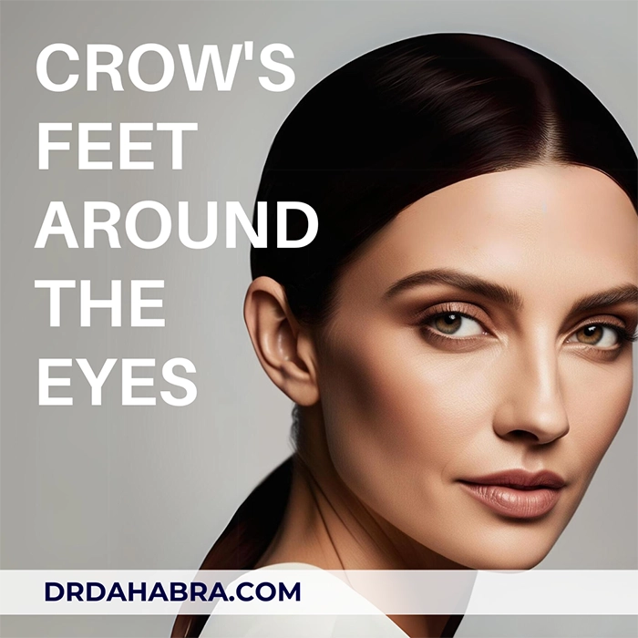 image of what is crows feet around the eyes